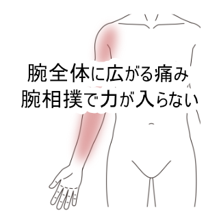 腕相撲で力が入らない 腕の重だるさのツボ ツボネット 鍼灸の症例が検索できるツボ辞典
