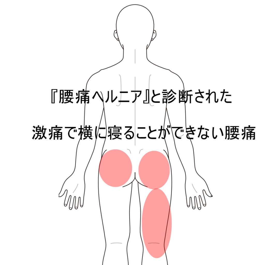 激痛で横になって寝ることができない腰痛｜腰痛のツボ｜ツボネット