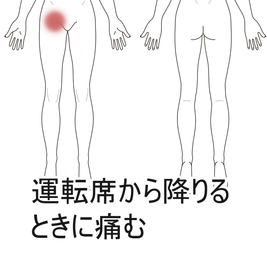 開脚のストレッチをしてから鼠径部が痛い｜股関節痛のツボ｜ツボネット 鍼灸の症例が検索できるツボ辞典