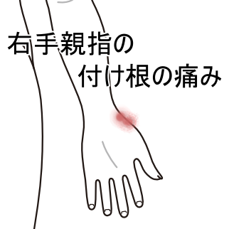 右親指付け根が手を着いたり パンチを打つと痛む 手首痛のツボ ツボネット 鍼灸の症例が検索できるツボ辞典