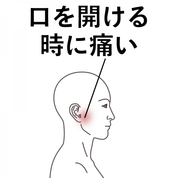 突然、顎関節が痛くなった例｜顎関節症のツボ｜ツボネット 鍼灸の症例が検索できるツボ辞典