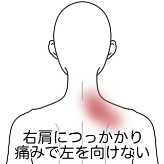 朝起きると 首の痛みで左に向けない 寝違え 首の痛み のツボ ツボネット 鍼灸の症例が検索できるツボ辞典