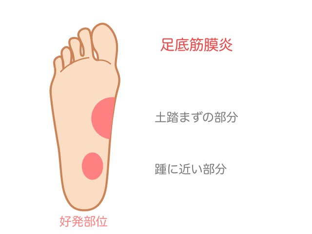 足底筋膜炎の好発部位