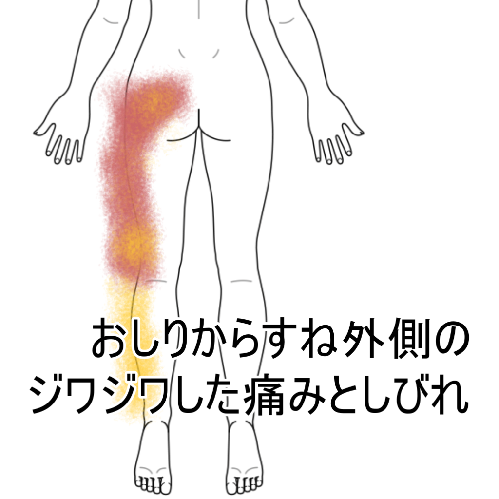 起床後１時間続く太ももからおしりの痛みとしびれ 脚 足 足指のしびれ 臀部痛のツボ ツボネット 鍼灸の症例が検索できるツボ辞典