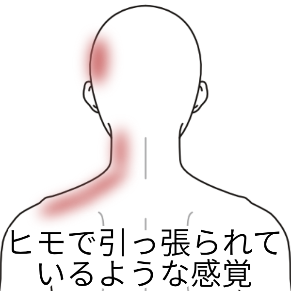 頭を傾けると 頚とコメカミが痛む 肩こり 首こりのツボ ツボネット 鍼灸の症例が検索できるツボ辞典