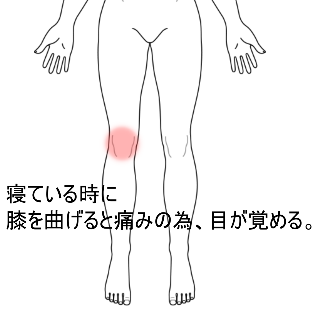 寝ている時に膝を伸ばすと痛みがある 膝痛のツボ ツボネット 鍼灸の症例が検索できるツボ辞典