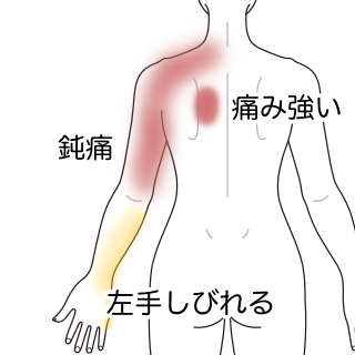 背部から痛みが広がり 左手がしびれる 腕 手指のしびれ 背部痛のツボ ツボネット 鍼灸の症例が検索できるツボ辞典