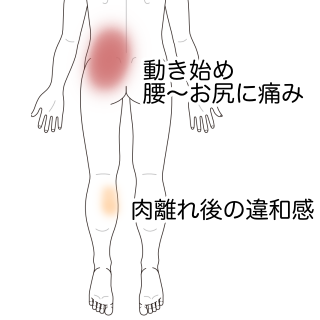 ふくらはぎ肉離れ後から 腰臀部の痛みが出現 臀部痛 腰痛のツボ ツボネット 鍼灸の症例が検索できるツボ辞典