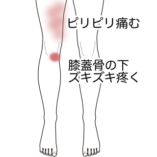 膝を深く曲げたり 体重を乗せると痛む 膝痛のツボ ツボネット 鍼灸の症例が検索できるツボ辞典