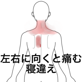 上下 左に首を動かすと痛む背中 寝違え 首の痛み 背部痛のツボ ツボネット 鍼灸の症例が検索できるツボ辞典