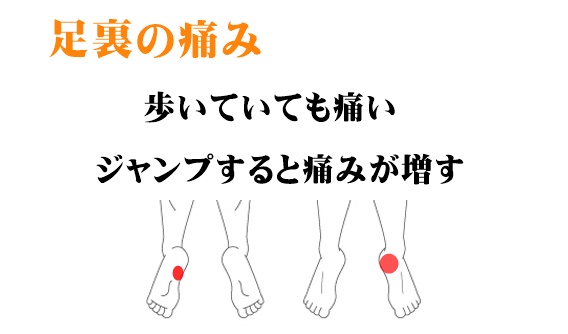 歩いていても足裏の踵 かかと 近くが痛い 足底筋膜炎 モートン病のツボ ツボネット 鍼灸の症例が検索できるツボ辞典