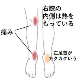 足首の堅さが原因と思われた膝の痛み 足首痛 膝痛のツボ ツボネット 鍼灸の症例が検索できるツボ辞典