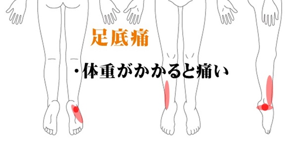 フルマラソン後 足裏の外側が痛い 足 足指の痛み 足底筋膜炎のツボ ツボネット 鍼灸の症例が検索できるツボ辞典