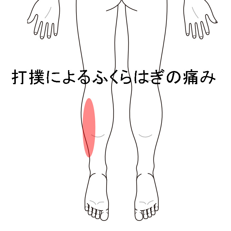 打撲によるふくらはぎの痛み 下腿の痛み 肉離れのツボ ツボネット 鍼灸の症例が検索できるツボ辞典