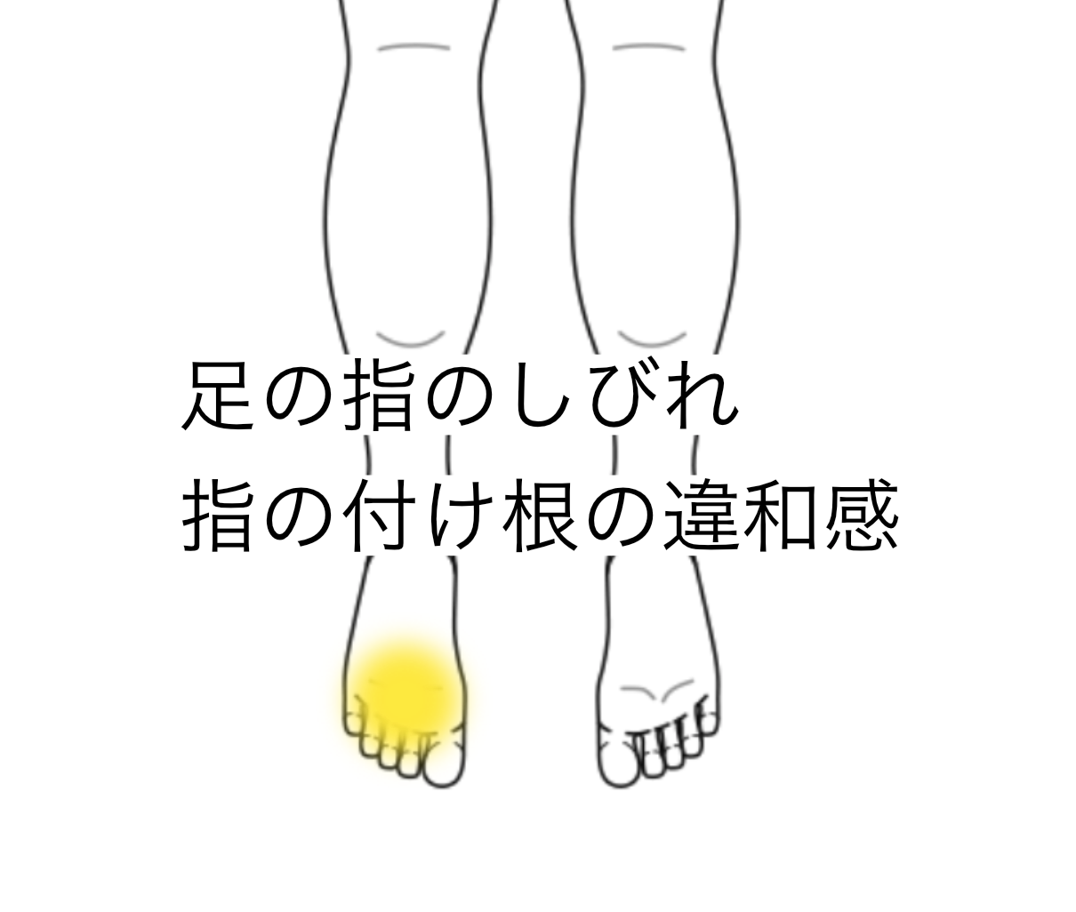 足趾のしびれをともなう痛みと 足趾付け根の違和感 脚 足 足指のしびれ 足 足指の痛みのツボ ツボネット 鍼灸の症例が検索できるツボ辞典