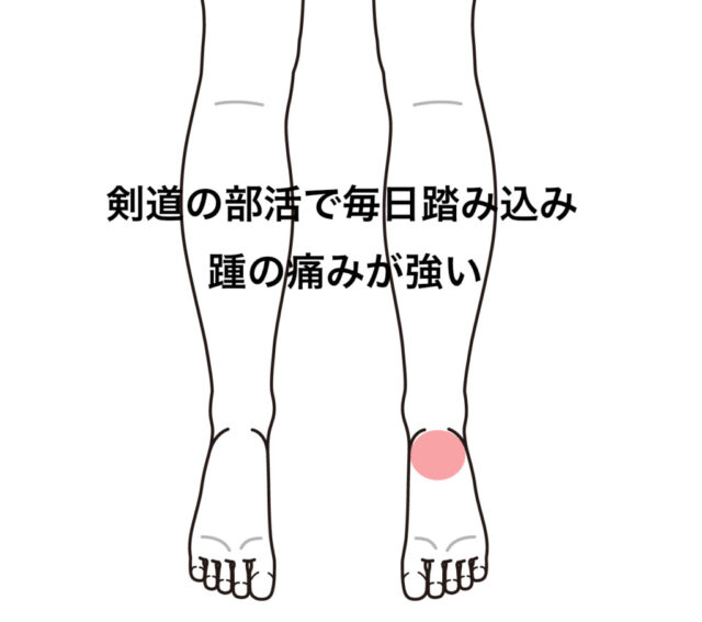 剣道で踏み込み過ぎて踵が痛い 足 足指の痛み 足底筋膜炎のツボ ツボネット 鍼灸の症例が検索できるツボ辞典