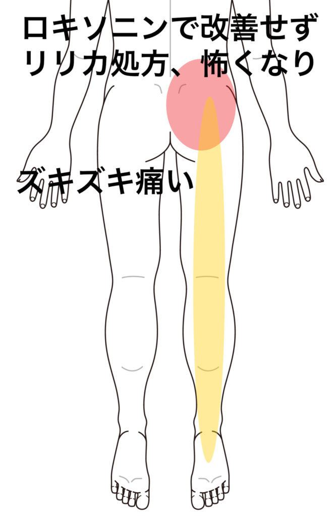 腰痛ベルト 足のしびれ トップ