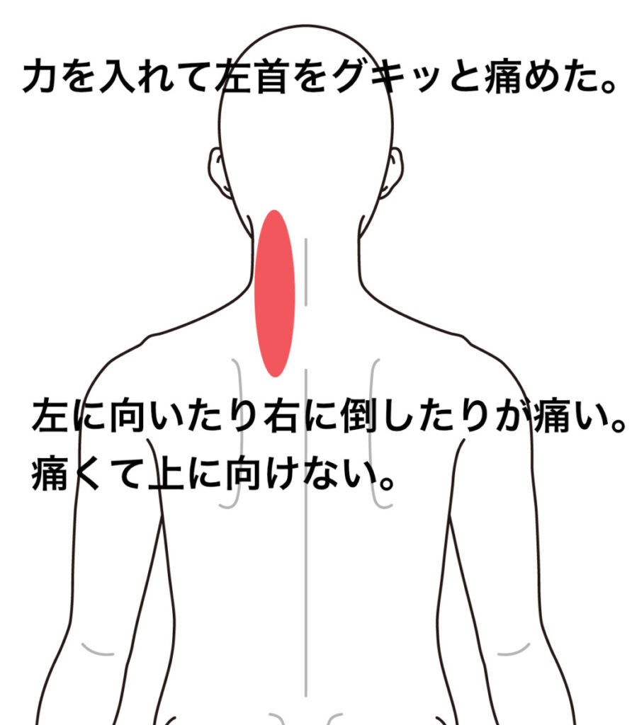 重たい患者さんを抱き上げて痛めた首 頚痛 寝違え 首の痛み のツボ ツボネット 鍼灸の症例が検索できるツボ辞典