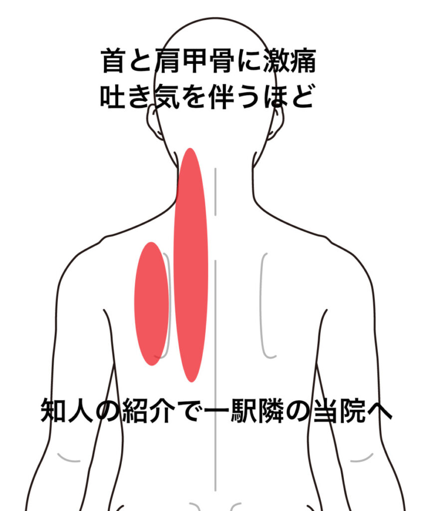 首と左肩甲骨周辺が痛い 頚痛 背部痛のツボ ツボネット 鍼灸の症例が検索できるツボ辞典