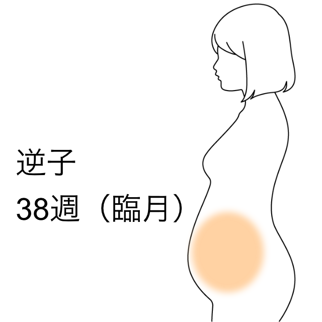 臨月 妊娠38週 で逆子になった 逆子 骨盤位 横位のツボ ツボネット 鍼灸の症例が検索できるツボ辞典