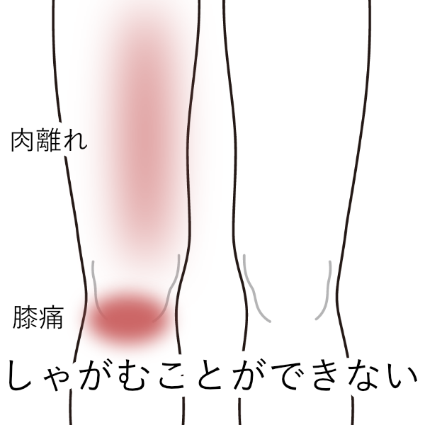 サッカー練習中に痛くなった膝 肉離れ 膝痛のツボ ツボネット 鍼灸の症例が検索できるツボ辞典