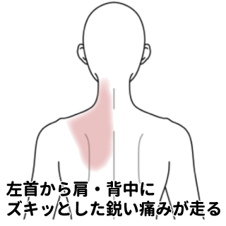 首肩から背中にかけての痛み 背部痛 肩こり 首こりのツボ ツボネット 鍼灸の症例が検索できるツボ辞典