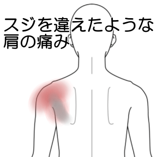 スジを違えたような左肩の痛み 五十肩 四十肩 のツボ ツボネット 鍼灸の症例が検索できるツボ辞典