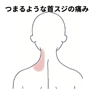 左側を振り向くと首筋が痛む 頚痛 肩こり 首こりのツボ ツボネット 鍼灸の症例が検索できるツボ辞典