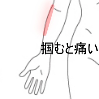 物を掴むと肘から腕にかけて痛む 腕の重だるさ 肘痛のツボ ツボネット 鍼灸の症例が検索できるツボ辞典