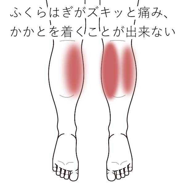 サーフィンで発症した 踵を着くことが出来ないふくらはぎの痛み 下腿の痛み 肉離れのツボ ツボネット 鍼灸の症例が検索できるツボ辞典