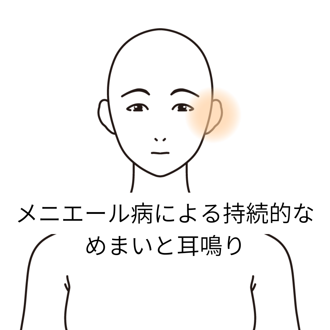 メニエール病による持続的なめまいと耳鳴り