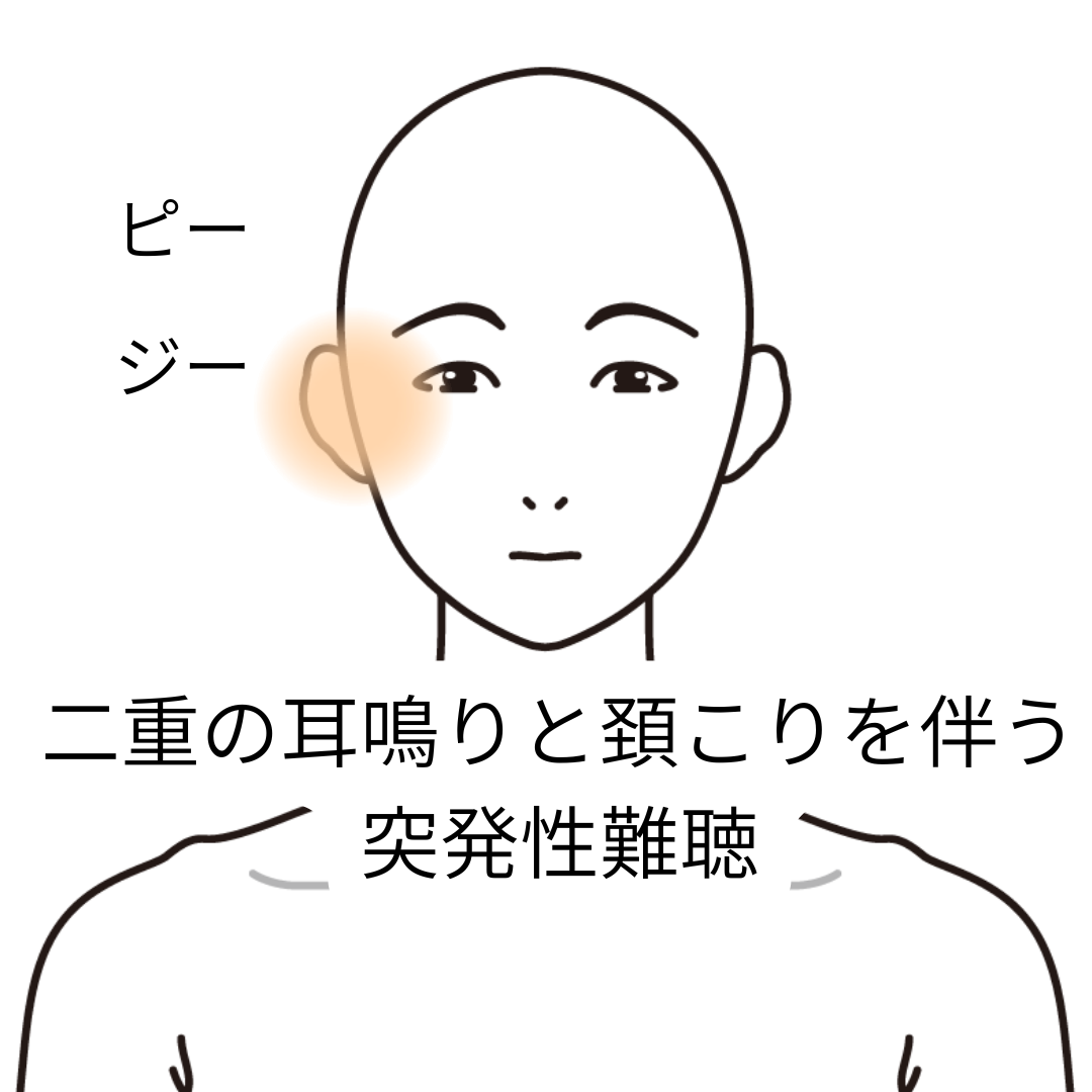 鍼灸症例「二重の耳鳴りと頚こりを伴う突発性難聴」症例（養気院／群馬県伊勢崎市）