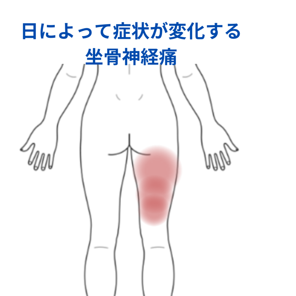 坐骨 神経痛 ツボ