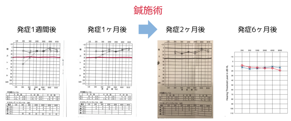 鍼灸症例_突発性難聴の改善例_オージオグラム（養気院／群馬県伊勢崎市）