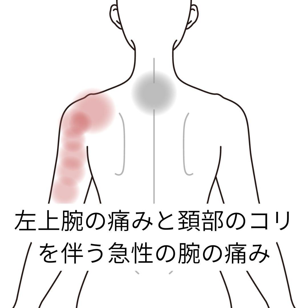 左上腕の痛みと頚部のコリ を伴う急性の腕の痛み