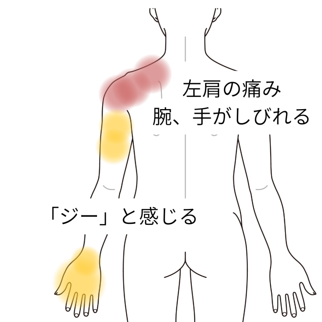 動かすとひどくなる左肩の痛みと腕のしびれ｜腕の痛み、腕・手指の