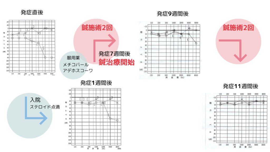 鍼灸症例_突発性難聴「発症7週間後の突発性難聴に対する鍼施術での著明な改善」のオージオフラムの変化