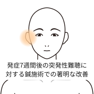 鍼灸症例「発症7週間後の突発性難聴に対する鍼施術での著名な改善」(カポス／東京都品川区)