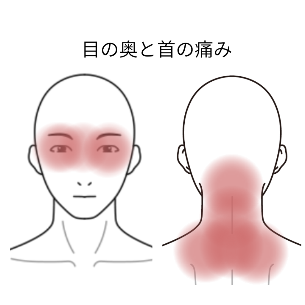 目の奥と首の痛みの図