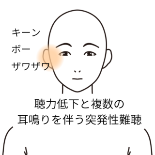 鍼灸症例「聴力低下と複数の耳鳴りを伴う突発性難聴」（養気院）