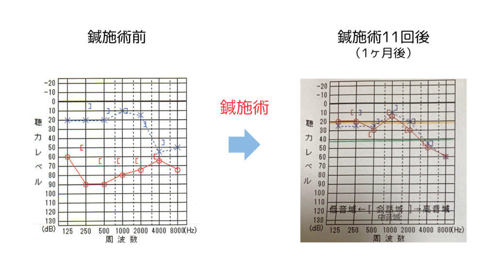 鍼灸症例「聴力低下と複数の耳鳴りを伴う突発性難聴」（養気院／群馬県伊勢崎市）