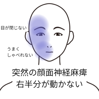 鍼灸症例「突然の顔面神経麻痺、右半分が動かない」（養気院／群馬県伊勢崎市）