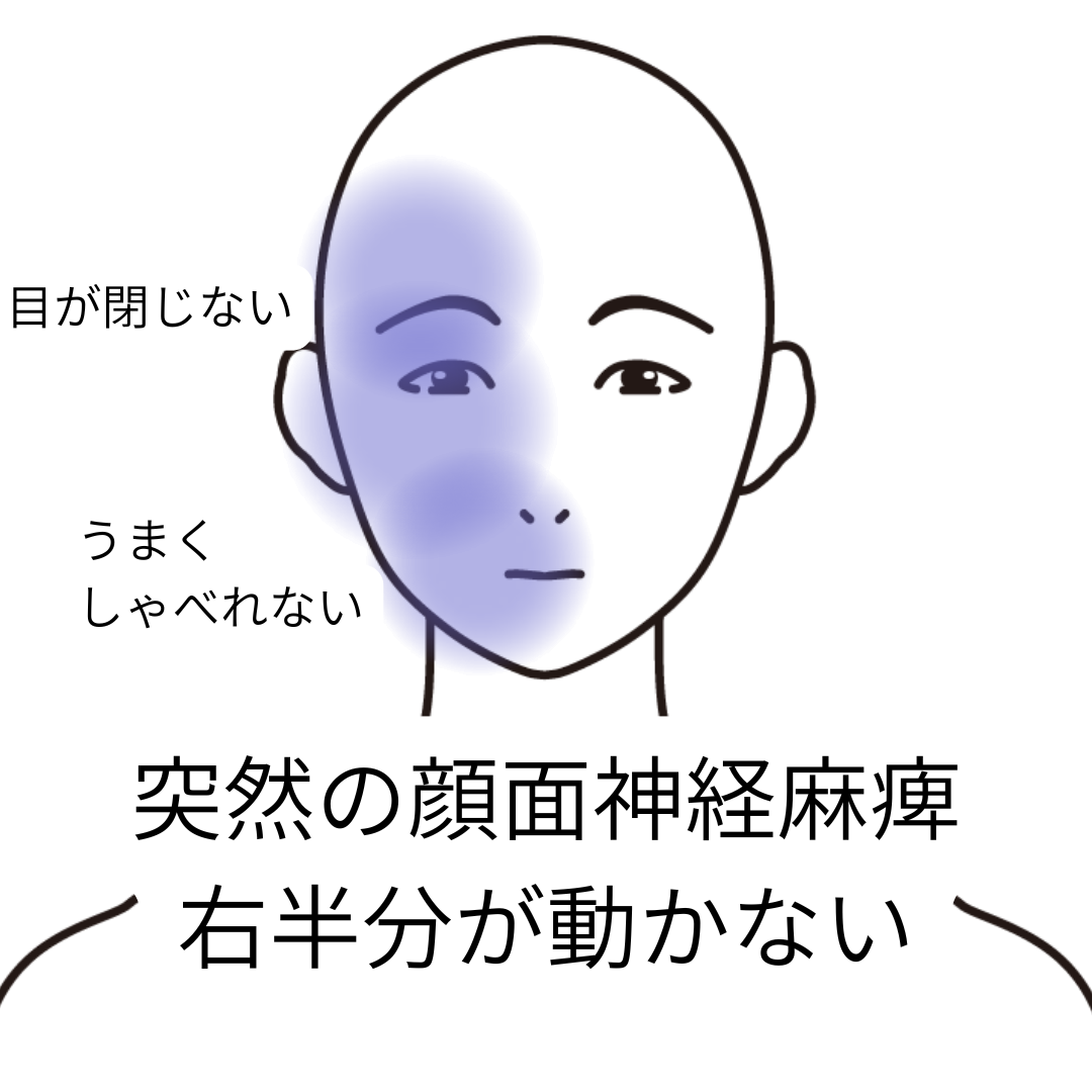 鍼灸症例「突然の顔面神経麻痺、右半分が動かない」（養気院／群馬県伊勢崎市）