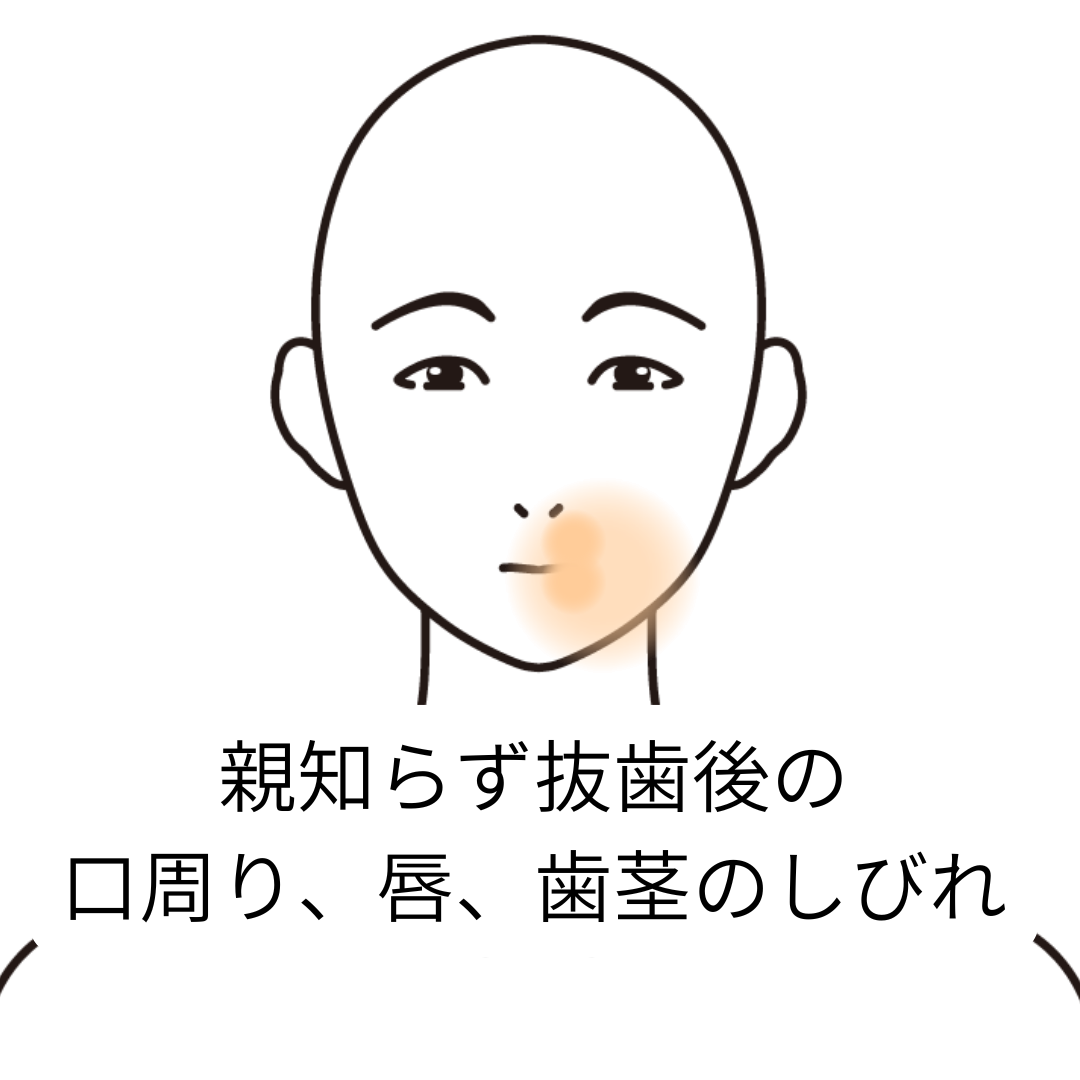 鍼灸症例「親知らず、抜歯後の口周り、唇、歯茎のしびれ」（養気院／群馬県伊勢崎市）