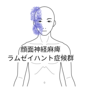 鍼灸の症例「ラムゼイハント症候群による顔面神経麻痺」(勝田駅)