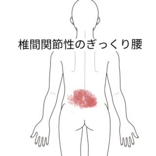 鍼灸の症例「伸展できないぎっくり腰」(勝田駅)