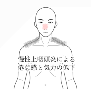 鍼灸の症例「慢性上咽頭炎による朝の倦怠感と気力低下の改善」(清澄白河)