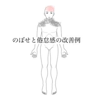 鍼灸の症例「全身のぼせと倦怠感の改善例」(清澄白河)