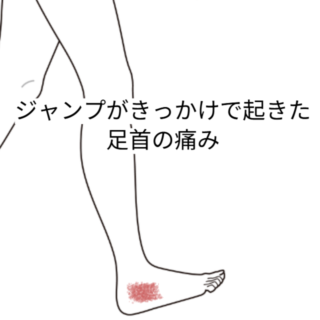 鍼灸の症例「体操練習でのくるぶし付近の痛み」(名鉄桜井駅/愛知県安城市)
