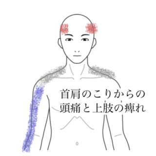 鍼灸の症例「首肩こりと頭痛、しびれの改善例」(清澄白河)